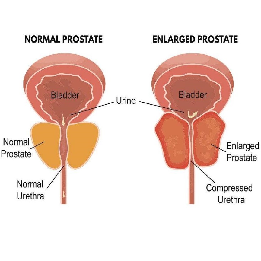 8pcs/многу Простата patch за Ослободување на Болката на prostatitis Бенигна простатична хиперплазија Папокот Sitcker